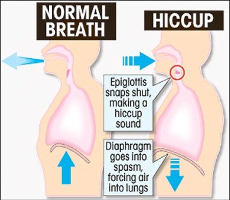 hiccups_diagram