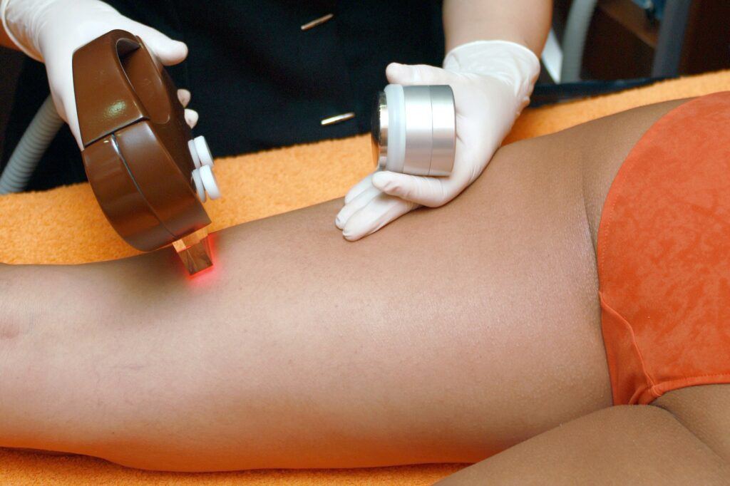 LASER hair removal treatment